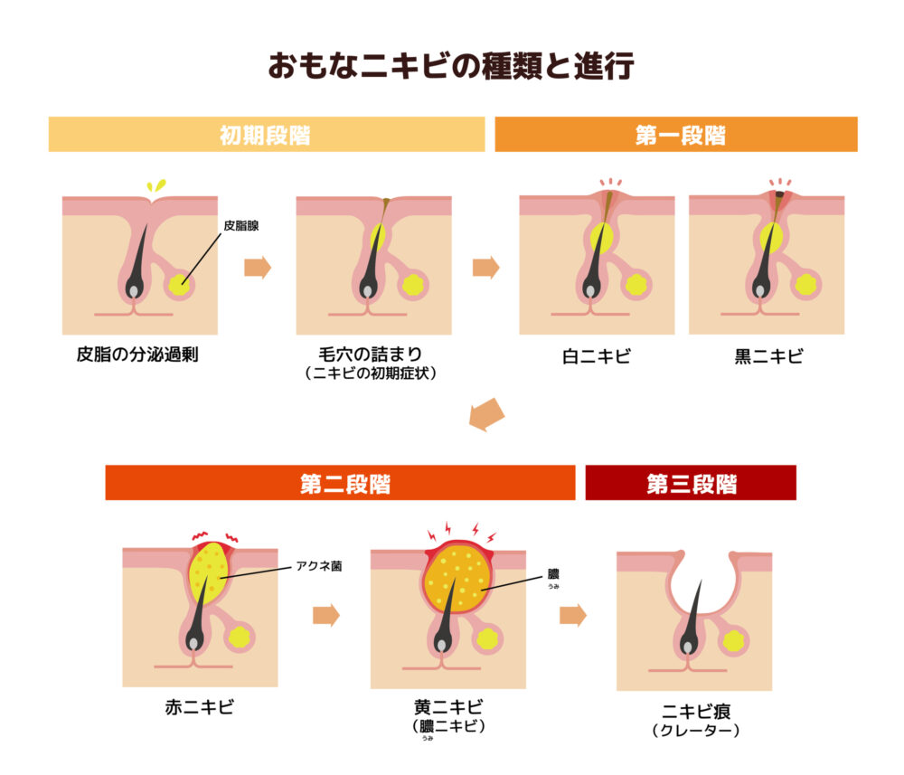 にきびの種類