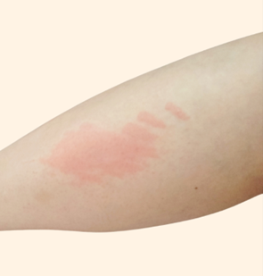 じんま疹