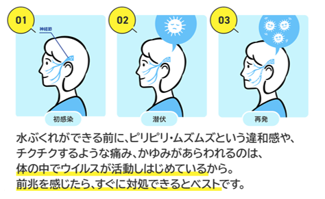 再発を繰り返す方へ：PIT療法