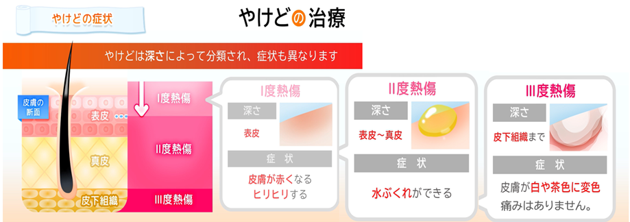 やけど（熱傷）