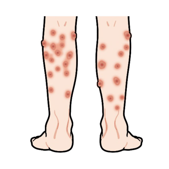 結節性痒疹（けっせつせいようしん）